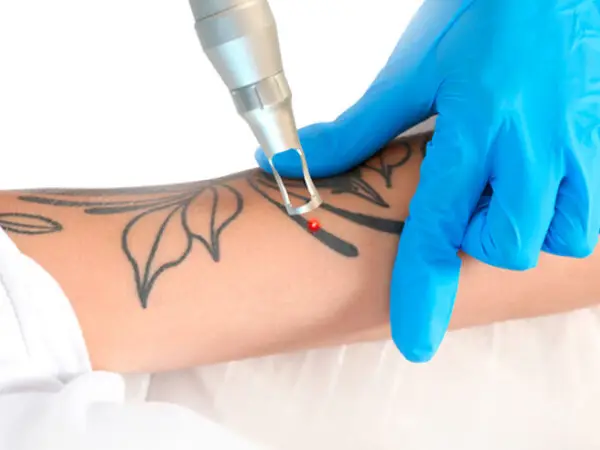 Tattoo Removal